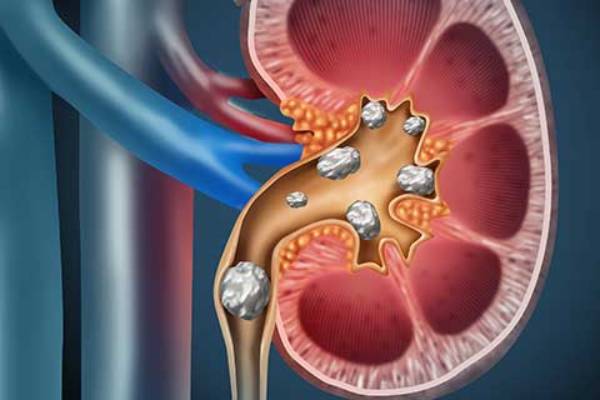 Ayurvedic Kidney Stone Treatment