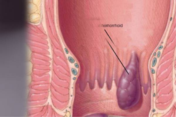 Piles & Fissure Ayurvedic Treatment