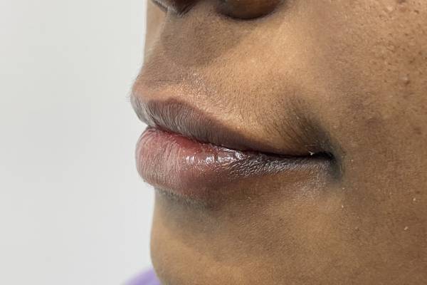 Ayurvedic Treatment for Dark Lips