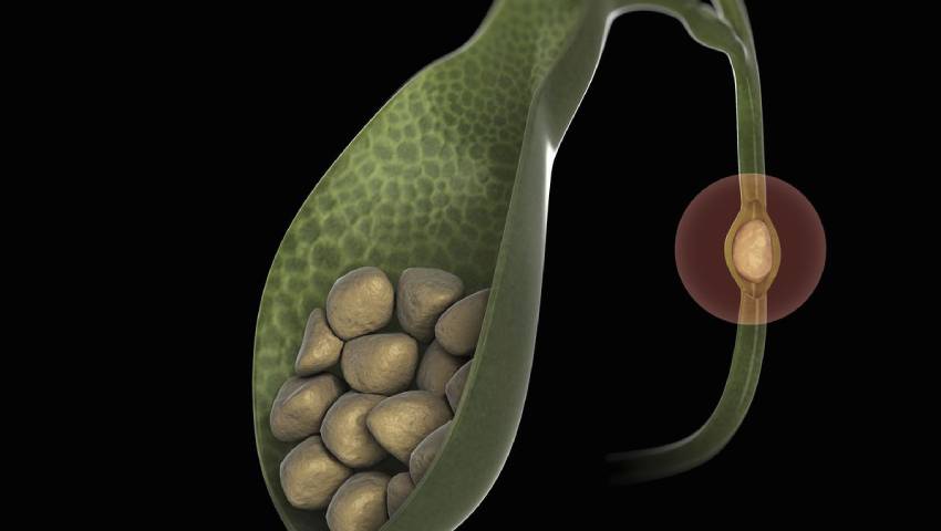 Ayurvedic Treatment For Gallstone